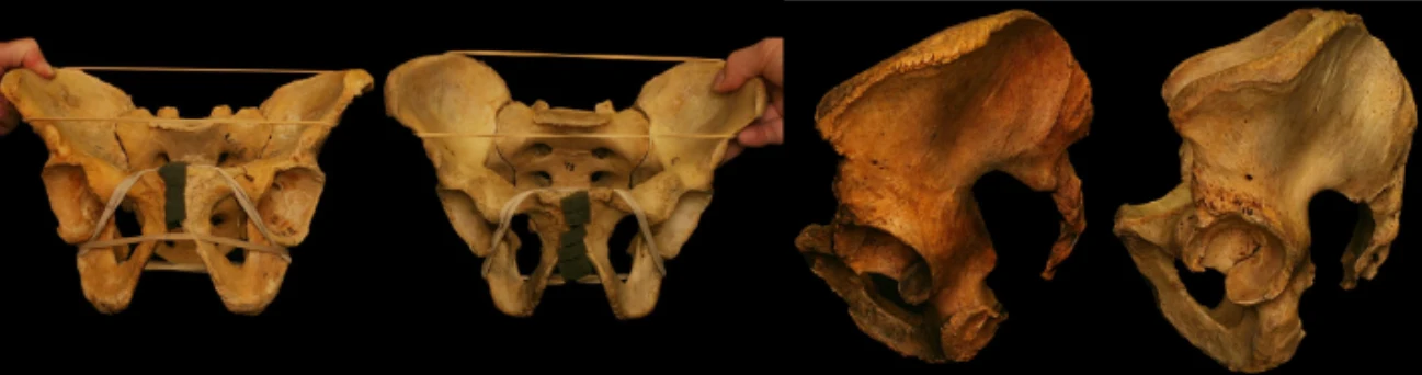 Comparación de dos pelvis y de sus acetábulos para mostrar diferencias anatómicas de la cadera.