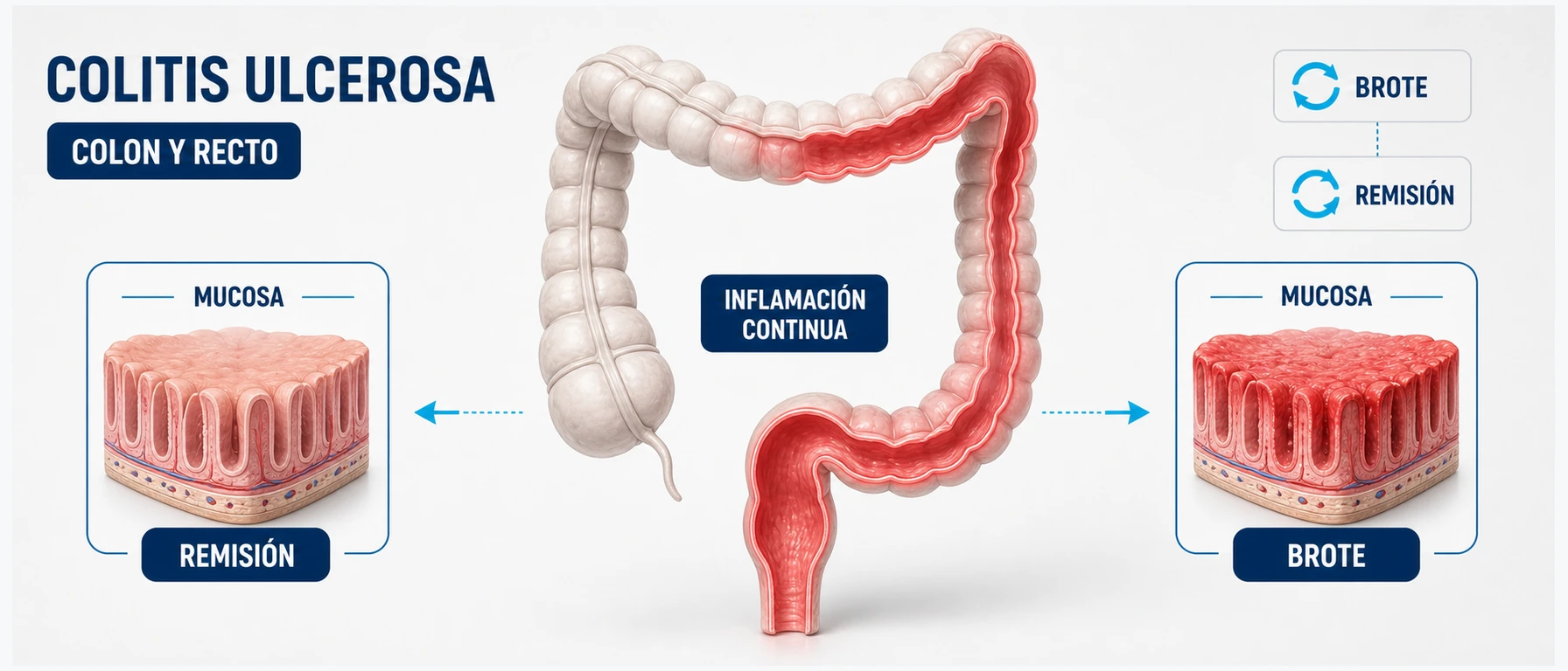 Infografía biomédica de colitis ulcerosa con inflamación continua del colon y recto y alternancia entre brote y remisión