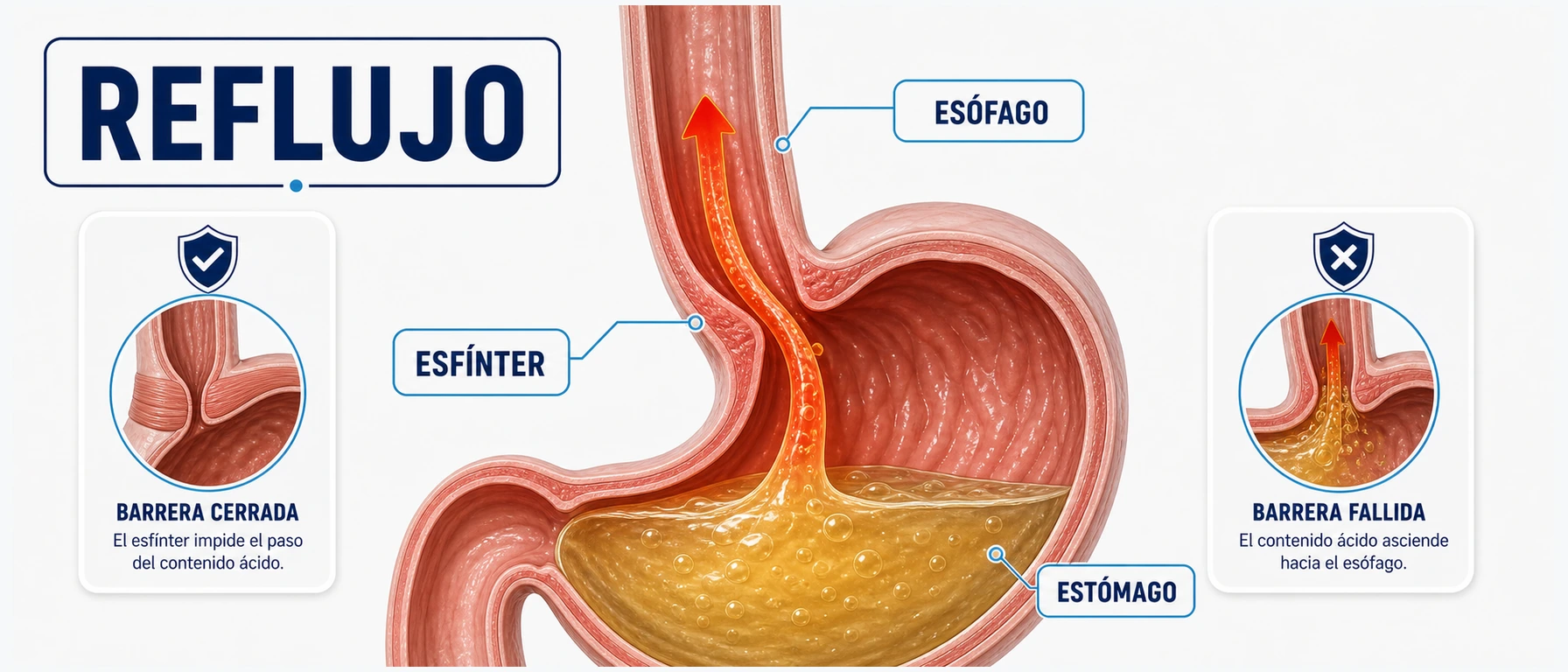 Infografía del mecanismo del reflujo gastroesofágico con esófago estómago y esfínter esofágico inferior