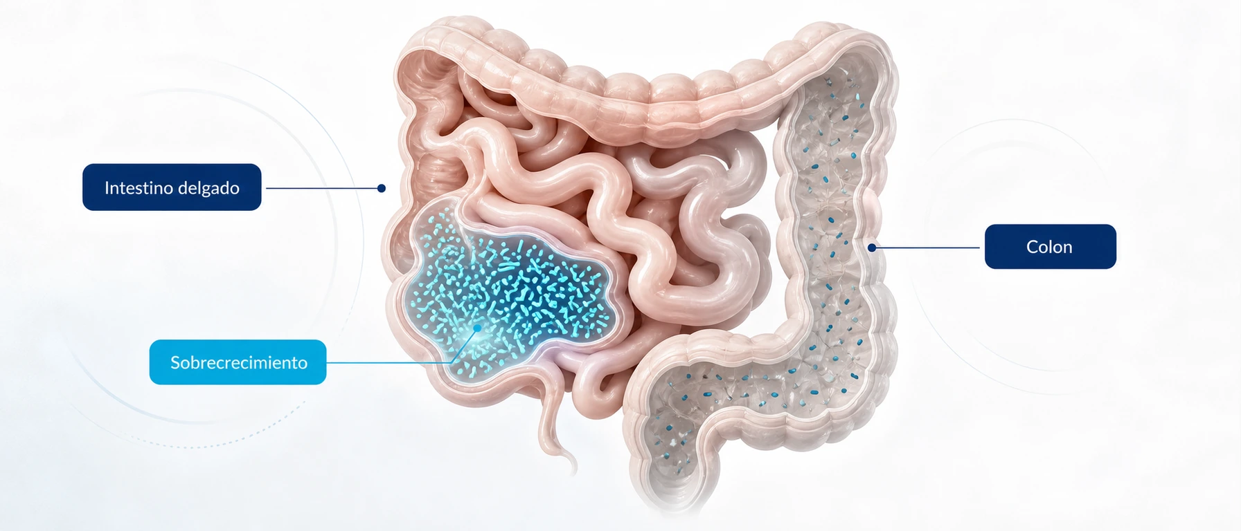 Infografía del SIBO como sobrecrecimiento bacteriano en el intestino delgado