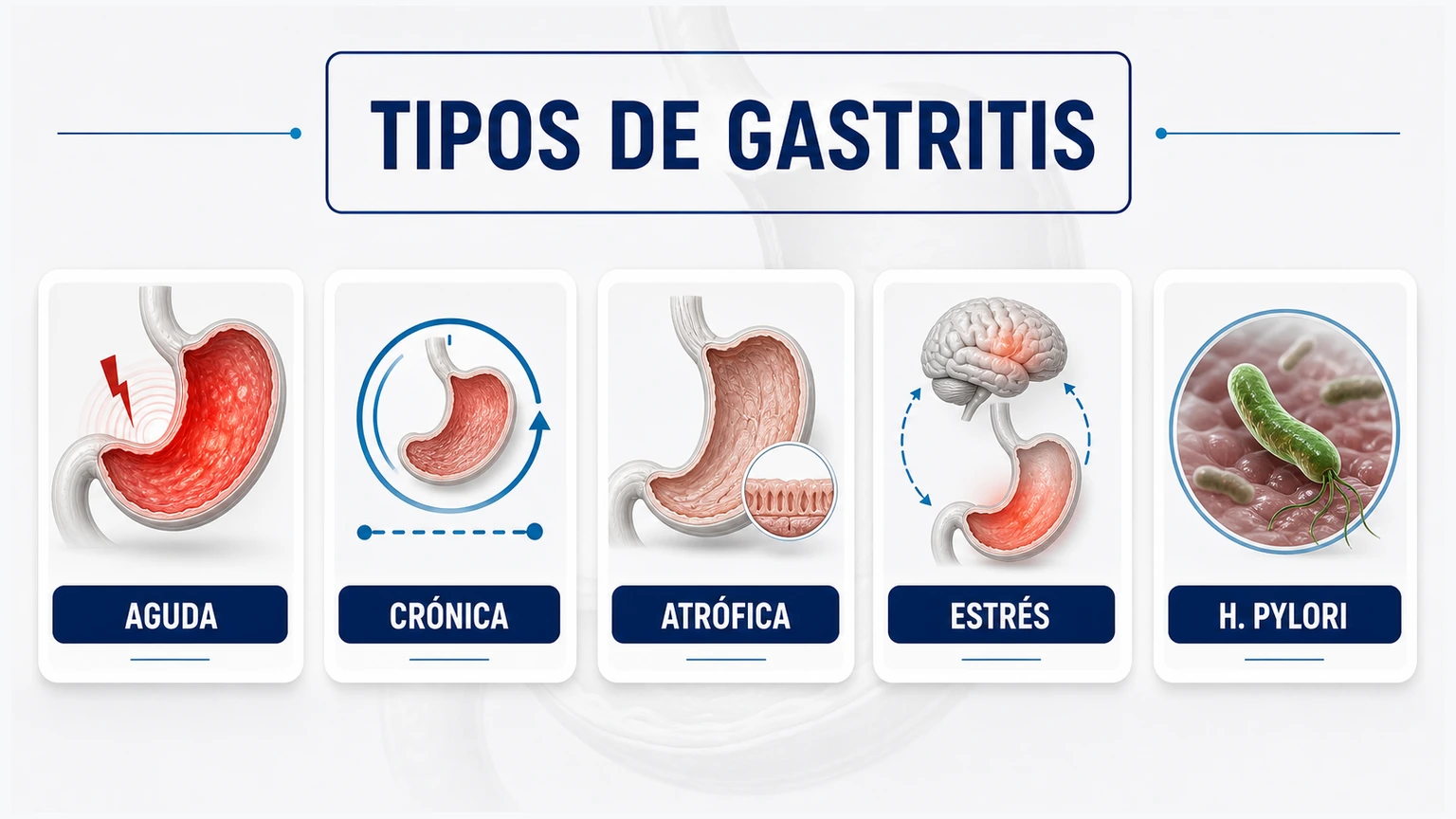 Tarjetas editoriales con tipos de gastritis aguda crónica atrófica por estrés y por Helicobacter pylori