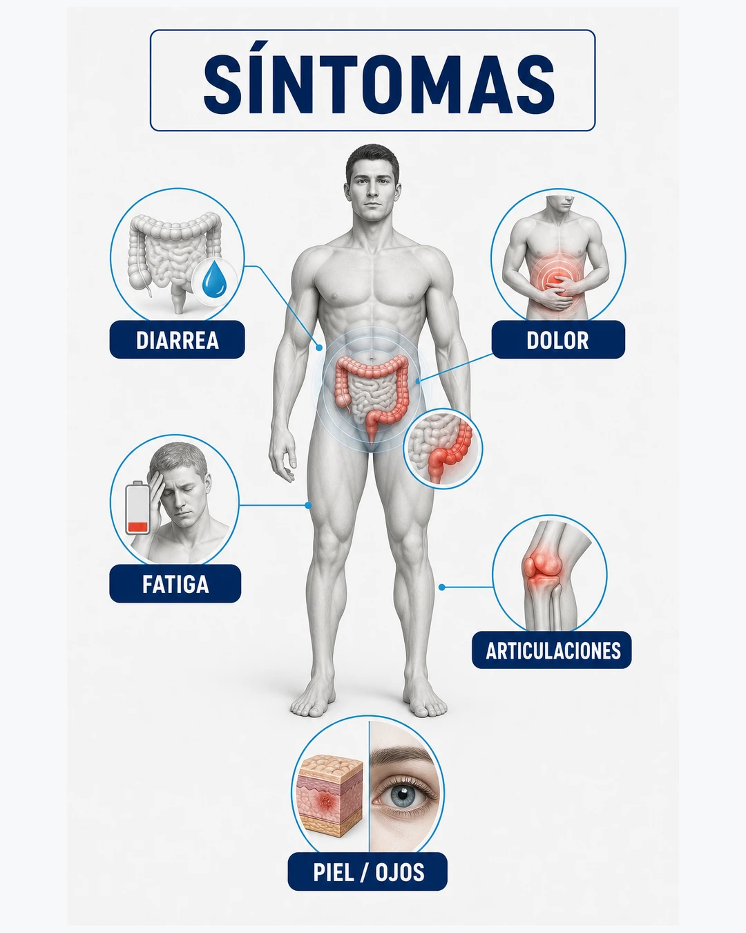 Ilustración anatómica de síntomas de enfermedad de Crohn como diarrea dolor fatiga articulaciones piel y ojos
