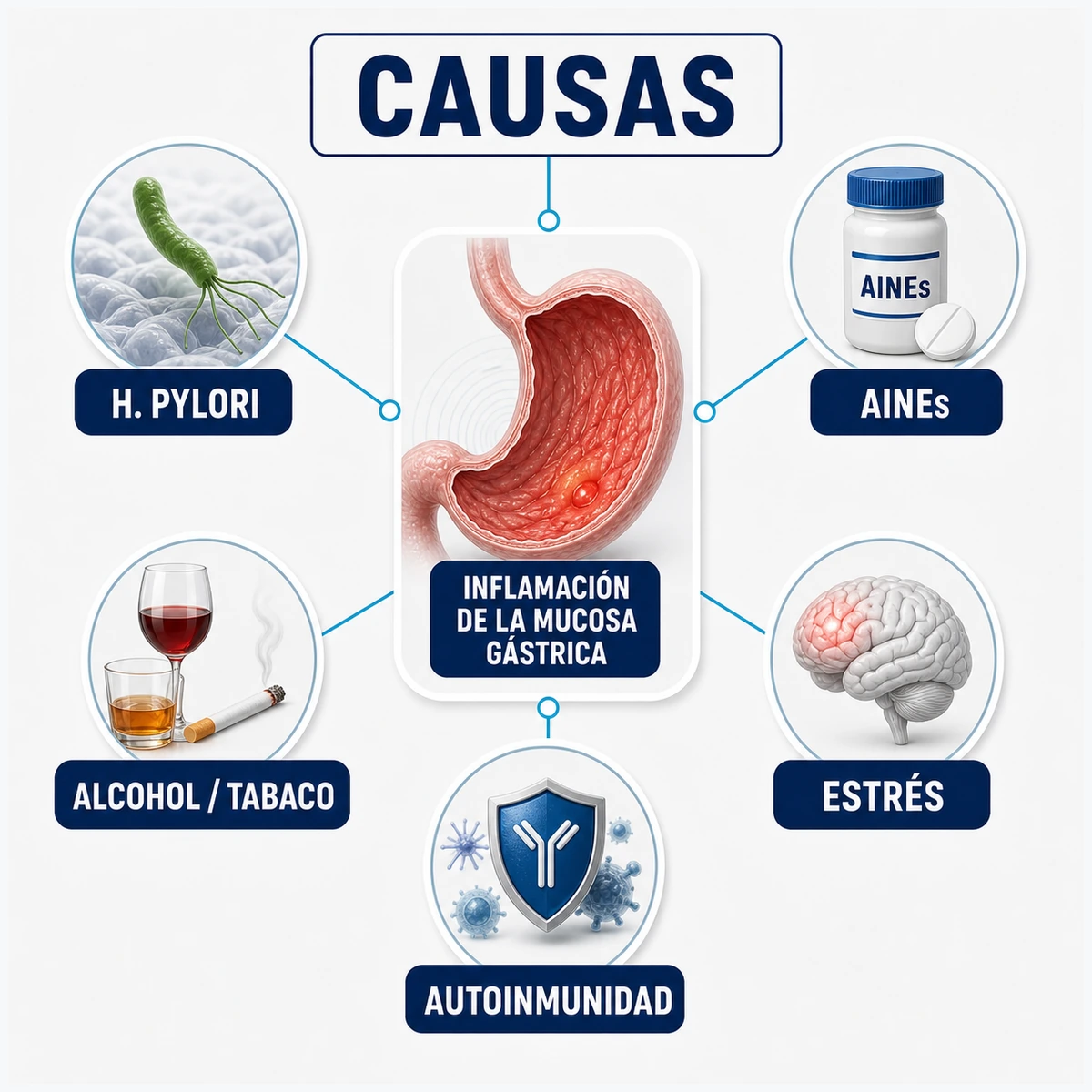 Mapa conceptual de causas de gastritis con Helicobacter pylori AINEs alcohol tabaco estrés y autoinmunidad