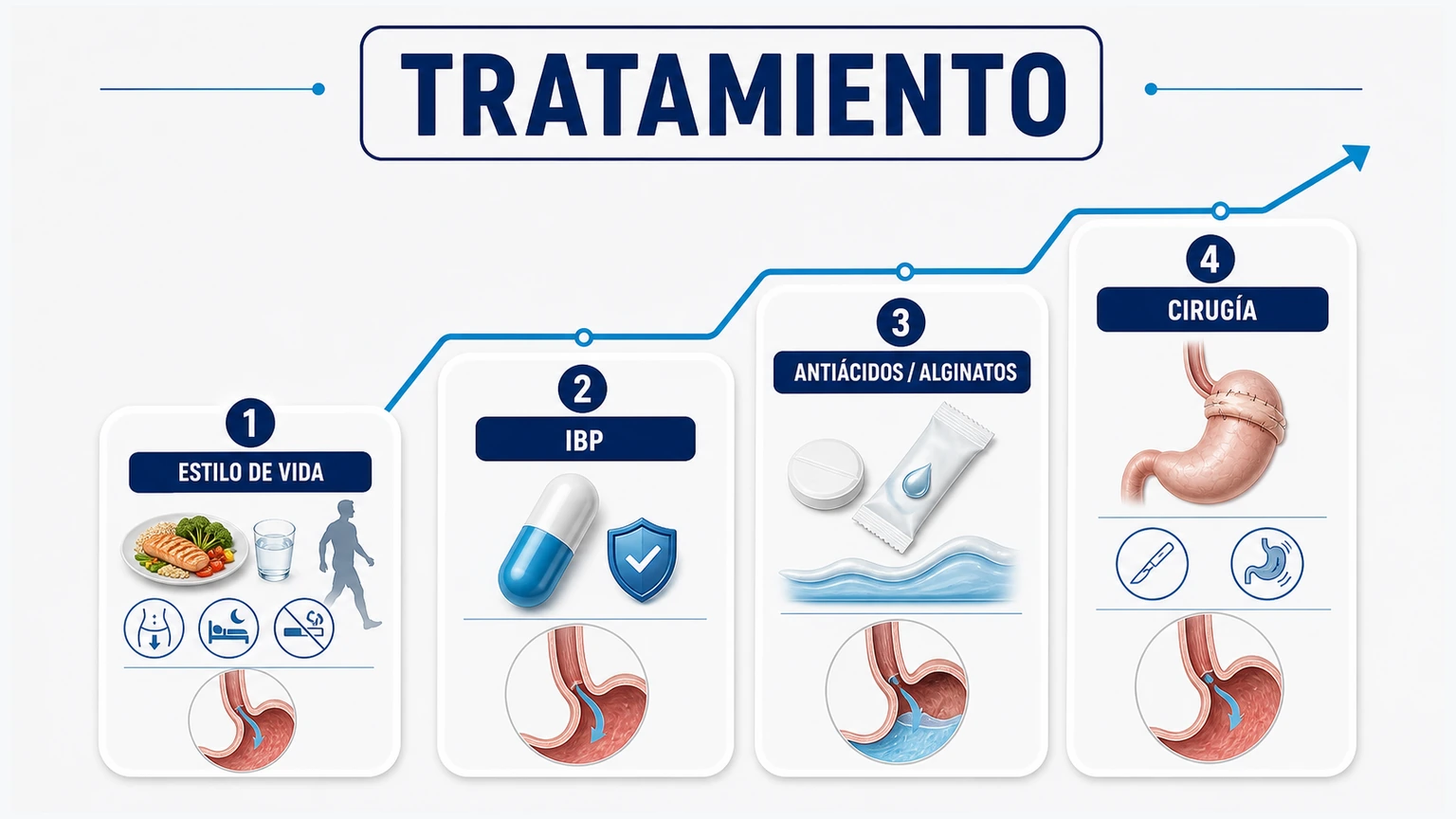 Escalera de tratamiento del reflujo con estilo de vida IBP antiácidos alginatos y cirugía