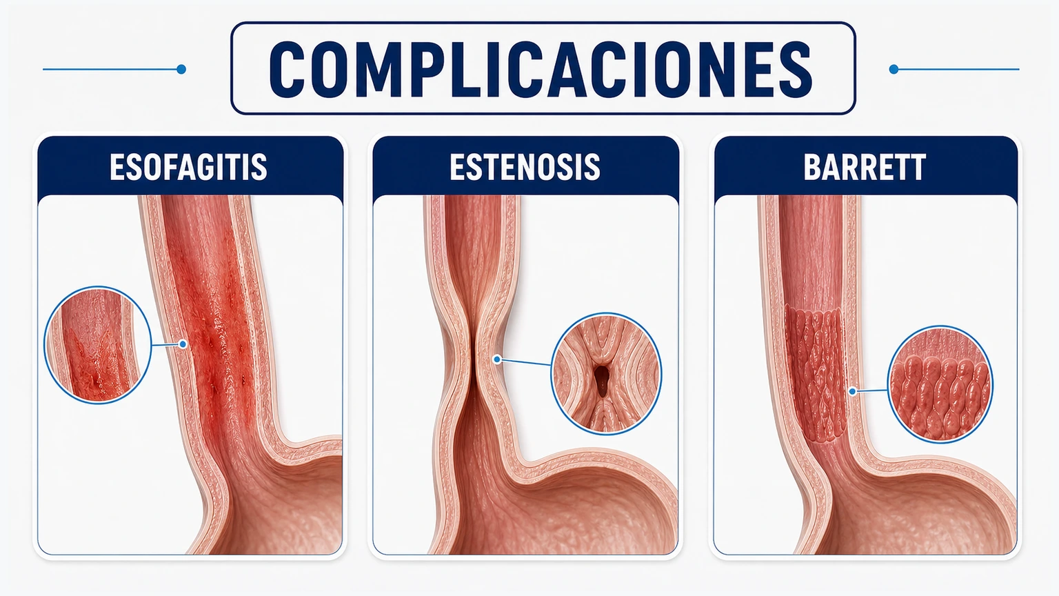 Comparativa de complicaciones del reflujo crónico con esofagitis estenosis y esófago de Barrett