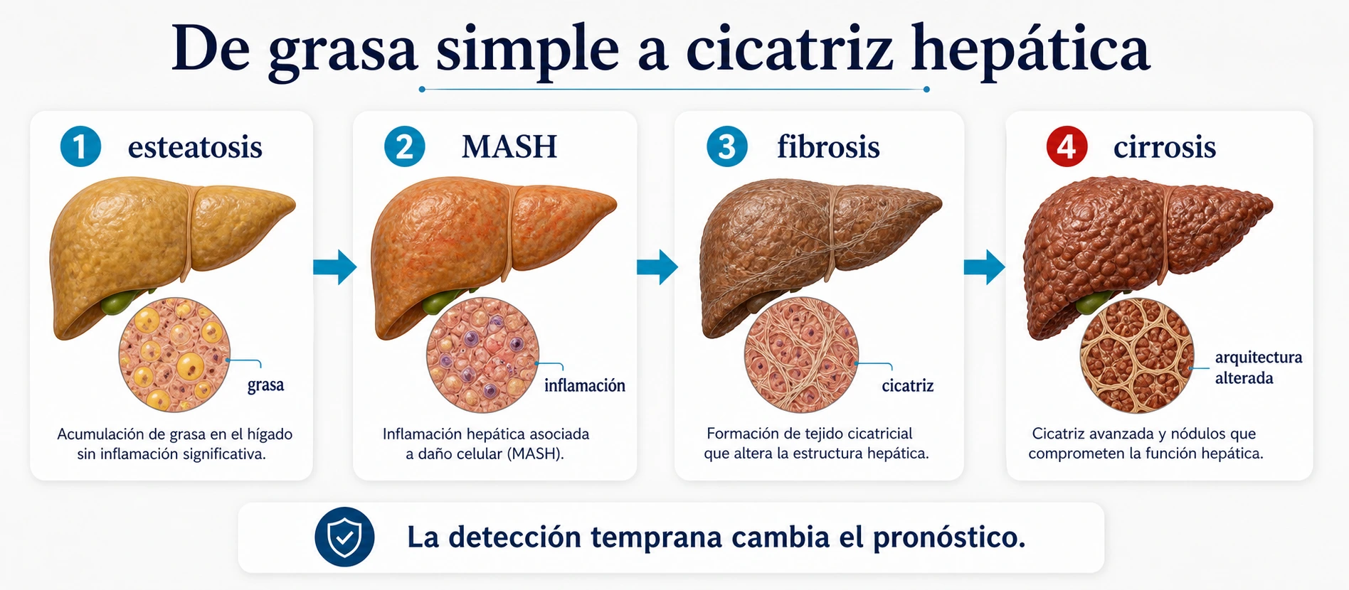 Progresion de los cuatro estadios del higado graso desde esteatosis y MASH hasta fibrosis y cirrosis